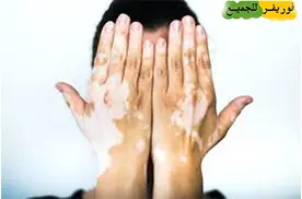 مجموعة البهاق من فوريفر